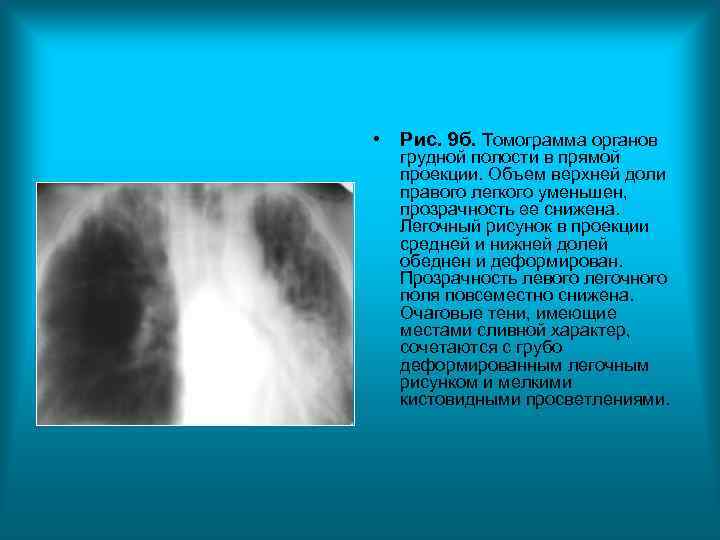 • Рис. 9 б. Томограмма органов грудной полости в прямой проекции. • Рис. 9 б. Томограмма органов грудной полости в прямой проекции.