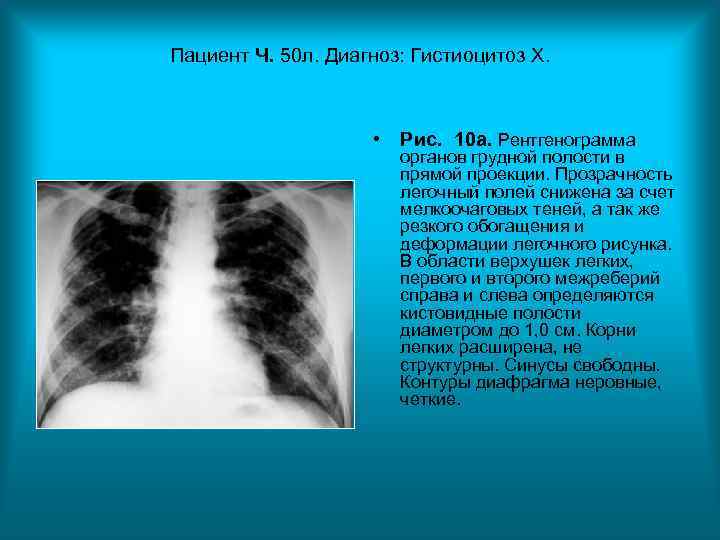 Пациент Ч. 50 л. Диагноз: Гистиоцитоз Х. • Рис. 10 Пациент Ч. 50 л. Диагноз: Гистиоцитоз Х. • Рис. 10