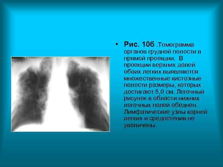 • Рис. 10 б. Томограмма органов грудной полости в прямой проекции. • Рис. 10 б. Томограмма органов грудной полости в прямой проекции.