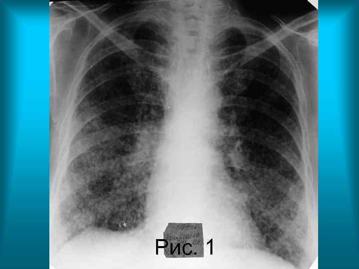 Рис. 1 Н. С. Воротынцева. С. С. Гольев Рентгенопульмонология Рис. 1 Н. С. Воротынцева. С. С. Гольев Рентгенопульмонология
