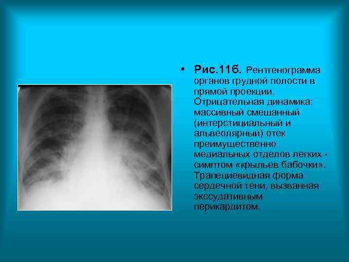 • Рис. 11 б. Рентгенограмма органов грудной полости в прямой проекции. • Рис. 11 б. Рентгенограмма органов грудной полости в прямой проекции.