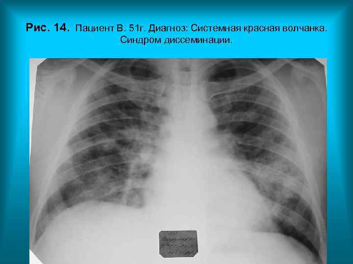 Рис. 14. Пациент В. 51 г. Диагноз: Системная красная волчанка. Рис. 14. Пациент В. 51 г. Диагноз: Системная красная волчанка.