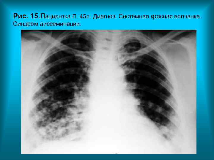 Рис. 15. Пациентка П. 45 л. Диагноз: Системная красная волчанка. Синдром диссеминации. Рис. 15. Пациентка П. 45 л. Диагноз: Системная красная волчанка. Синдром диссеминации.