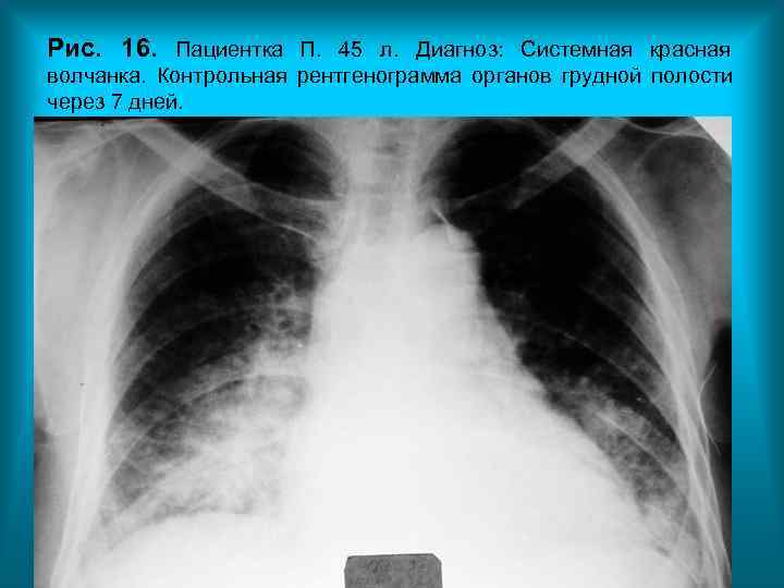 Рис. 16. Пациентка П. 45 л. Диагноз: Системная красная волчанка. Контрольная рентгенограмма органов грудной Рис. 16. Пациентка П. 45 л. Диагноз: Системная красная волчанка. Контрольная рентгенограмма органов грудной