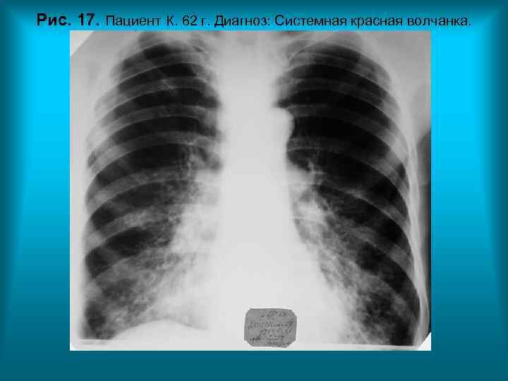 Рис. 17. Пациент К. 62 г. Диагноз: Системная красная волчанка. Рис. 17. Пациент К. 62 г. Диагноз: Системная красная волчанка.