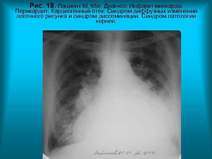 Рис. 18. Пациент М. 65 л. Диагноз: Инфаркт миокарда. Перикардит. Кардиогенный отек. Рис. 18. Пациент М. 65 л. Диагноз: Инфаркт миокарда. Перикардит. Кардиогенный отек.