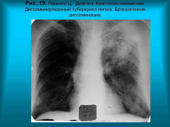 Рис. 19. Пациент Ц. Диагноз: Казеозная пневмония. Диссеминированный туберкулез легких. Бронхогенная диссеминация. Рис. 19. Пациент Ц. Диагноз: Казеозная пневмония. Диссеминированный туберкулез легких. Бронхогенная диссеминация.
