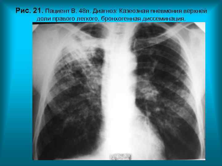 Рис. 21. Пациент В. 48 л. Диагноз: Казеозная пневмония верхней доли правого легкого, Рис. 21. Пациент В. 48 л. Диагноз: Казеозная пневмония верхней доли правого легкого,