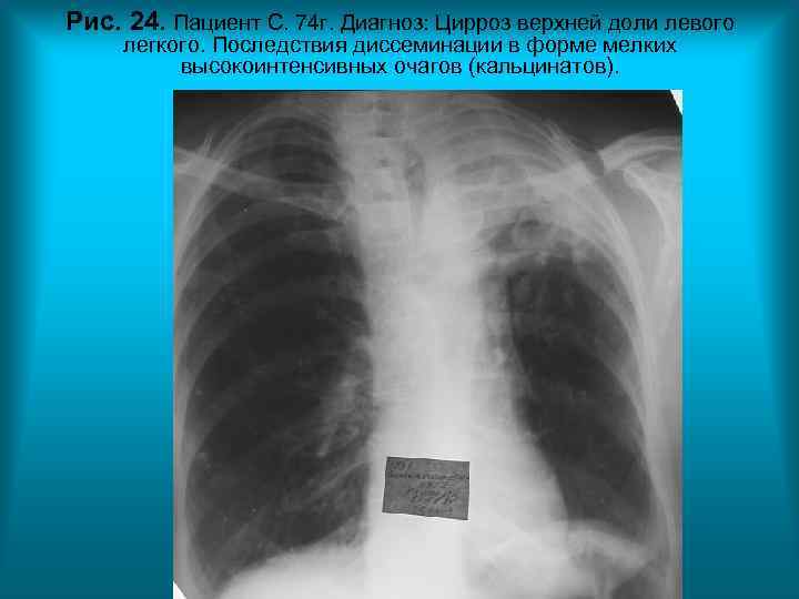 Рис. 24. Пациент С. 74 г. Диагноз: Цирроз верхней доли левого легкого. Последствия диссеминации Рис. 24. Пациент С. 74 г. Диагноз: Цирроз верхней доли левого легкого. Последствия диссеминации