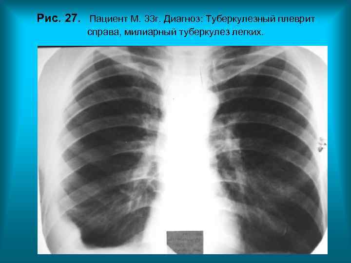 Рис. 27. Пациент М. 33 г. Диагноз: Туберкулезный плеврит справа, милиарный туберкулез легких. Рис. 27. Пациент М. 33 г. Диагноз: Туберкулезный плеврит справа, милиарный туберкулез легких.