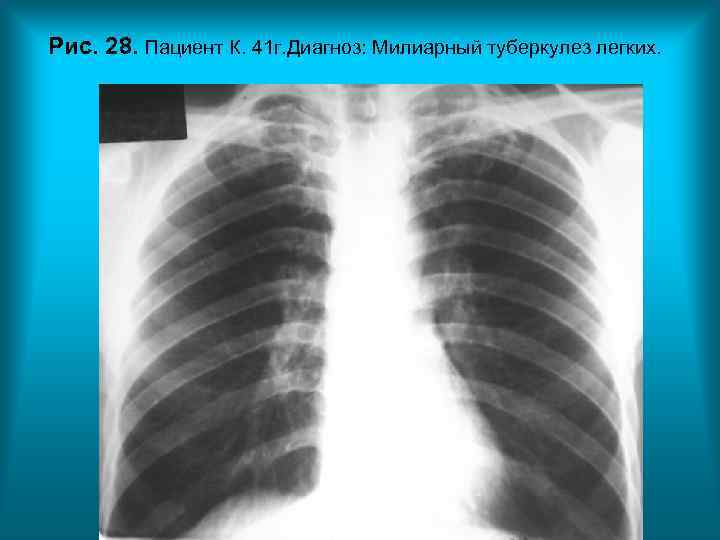 Рис. 28. Пациент К. 41 г. Диагноз: Милиарный туберкулез легких. Рис. 28. Пациент К. 41 г. Диагноз: Милиарный туберкулез легких.