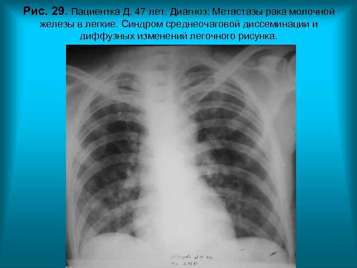 Рис. 29. Пациентка Д. 47 лет. Диагноз: Метастазы рака молочной железы в легкие. Рис. 29. Пациентка Д. 47 лет. Диагноз: Метастазы рака молочной железы в легкие.