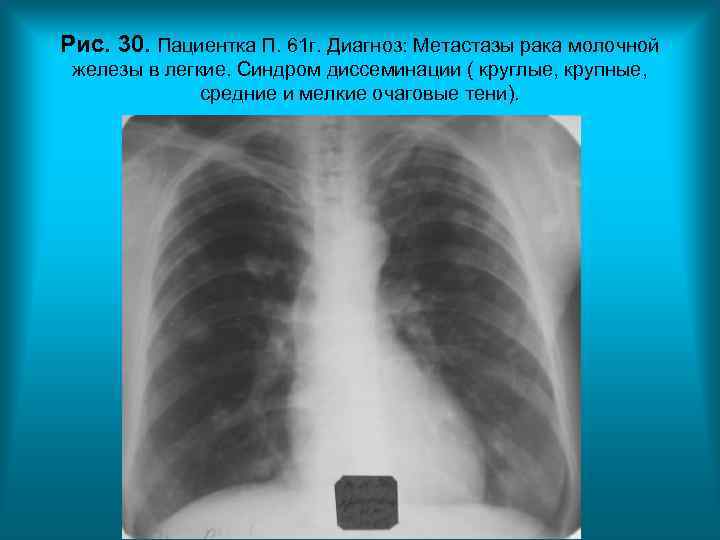 Рис. 30. Пациентка П. 61 г. Диагноз: Метастазы рака молочной железы в легкие. Синдром Рис. 30. Пациентка П. 61 г. Диагноз: Метастазы рака молочной железы в легкие. Синдром