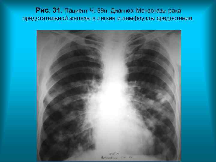 Рис. 31. Пациент Ч. 59 л. Диагноз: Метастазы рака предстательной железы в Рис. 31. Пациент Ч. 59 л. Диагноз: Метастазы рака предстательной железы в