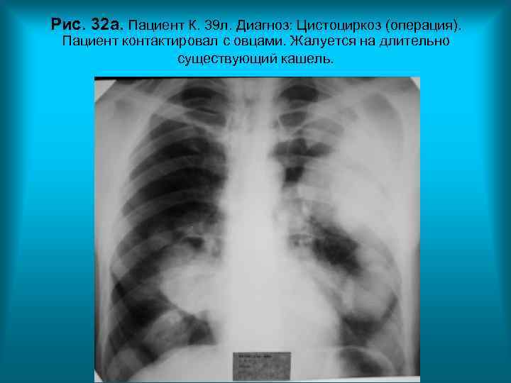 Рис. 32 а. Пациент К. 39 л. Диагноз: Цистоциркоз (операция). Пациент контактировал с Рис. 32 а. Пациент К. 39 л. Диагноз: Цистоциркоз (операция). Пациент контактировал с