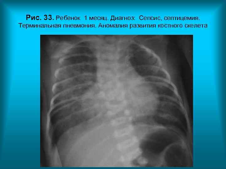Рис. 33. Ребенок 1 месяц. Диагноз: Сепсис, септицемия. Терминальная пневмония. Аномалия развития костного Рис. 33. Ребенок 1 месяц. Диагноз: Сепсис, септицемия. Терминальная пневмония. Аномалия развития костного