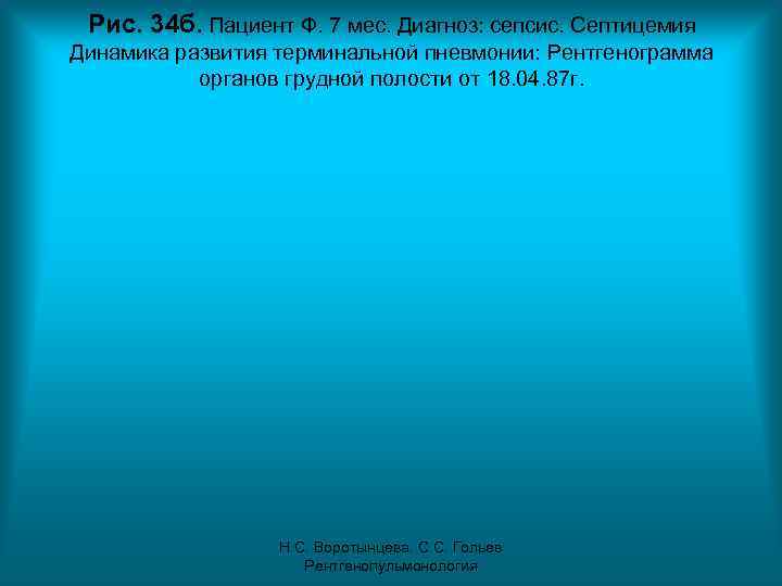 Рис. 34 б. Пациент Ф. 7 мес. Диагноз: сепсис. Септицемия Динамика развития терминальной Рис. 34 б. Пациент Ф. 7 мес. Диагноз: сепсис. Септицемия Динамика развития терминальной