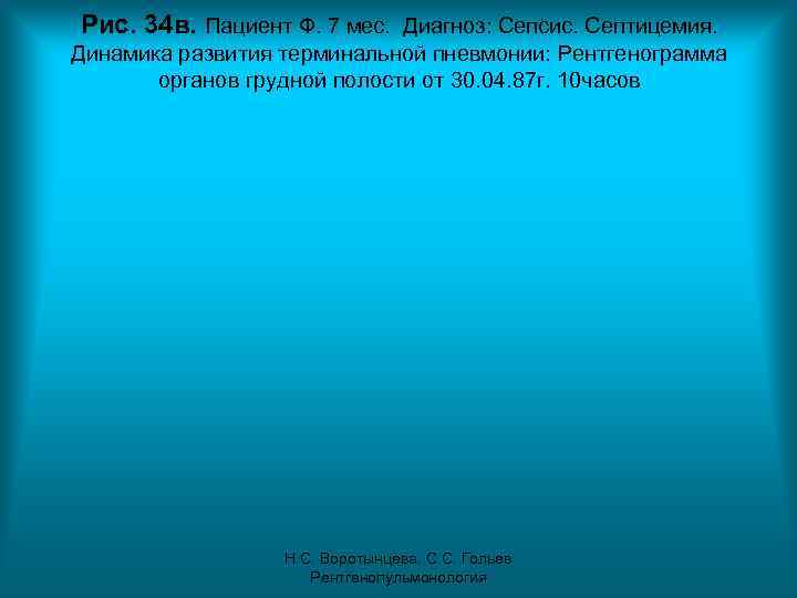 Рис. 34 в. Пациент Ф. 7 мес. Диагноз: Сепсис. Септицемия. Динамика развития терминальной пневмонии: Рис. 34 в. Пациент Ф. 7 мес. Диагноз: Сепсис. Септицемия. Динамика развития терминальной пневмонии: