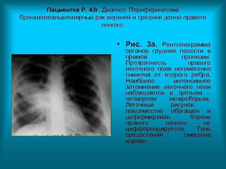 Пациентка Р. 43 г. Диагноз: Периферический бронхиолоальвеолярный рак верхней и средней долей Пациентка Р. 43 г. Диагноз: Периферический бронхиолоальвеолярный рак верхней и средней долей