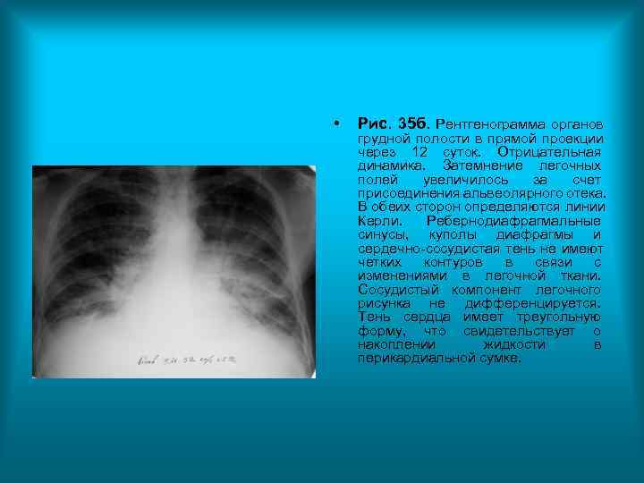 • Рис. 35 б. Рентгенограмма органов грудной полости в прямой проекции через • Рис. 35 б. Рентгенограмма органов грудной полости в прямой проекции через