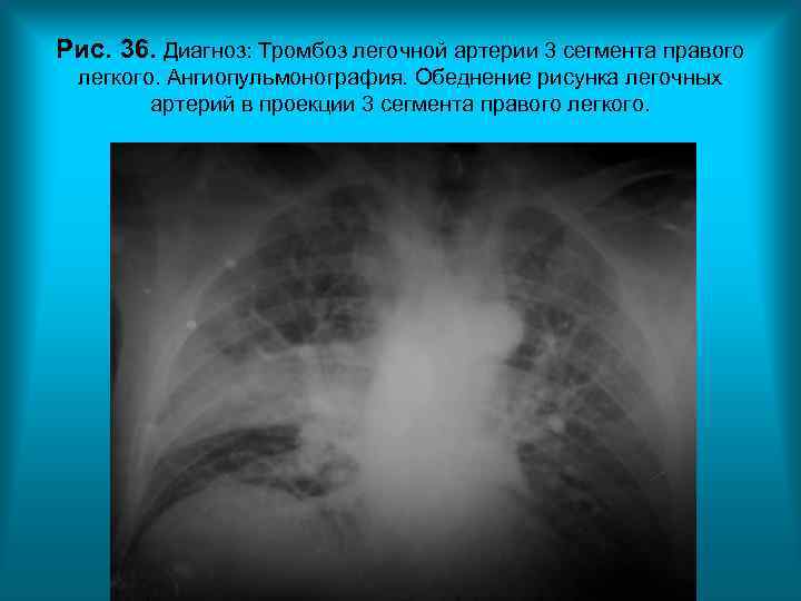 Рис. 36. Диагноз: Тромбоз легочной артерии 3 сегмента правого легкого. Ангиопульмонография. Обеднение рисунка легочных Рис. 36. Диагноз: Тромбоз легочной артерии 3 сегмента правого легкого. Ангиопульмонография. Обеднение рисунка легочных