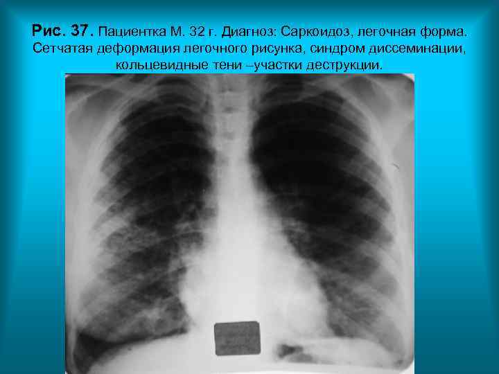 Рис. 37. Пациентка М. 32 г. Диагноз: Саркоидоз, легочная форма. Сетчатая деформация легочного рисунка, Рис. 37. Пациентка М. 32 г. Диагноз: Саркоидоз, легочная форма. Сетчатая деформация легочного рисунка,