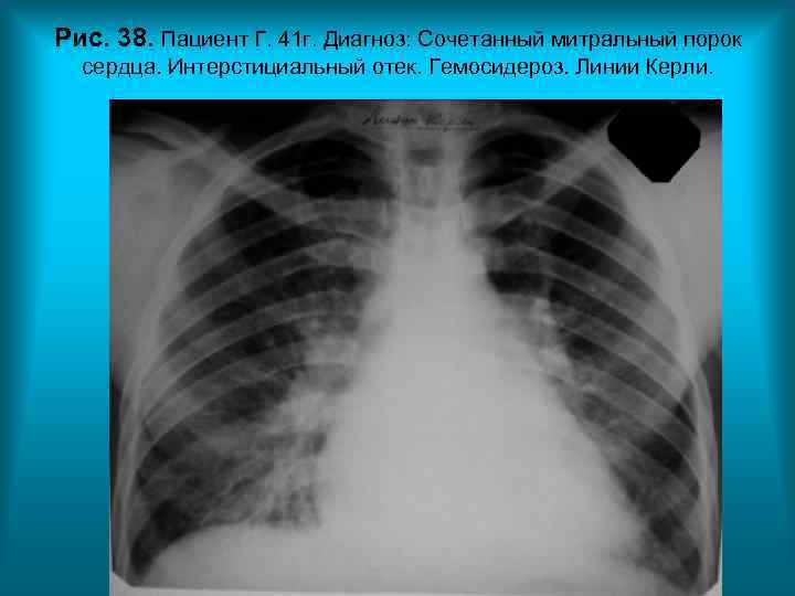 Рис. 38. Пациент Г. 41 г. Диагноз: Сочетанный митральный порок сердца. Интерстициальный отек. Рис. 38. Пациент Г. 41 г. Диагноз: Сочетанный митральный порок сердца. Интерстициальный отек.