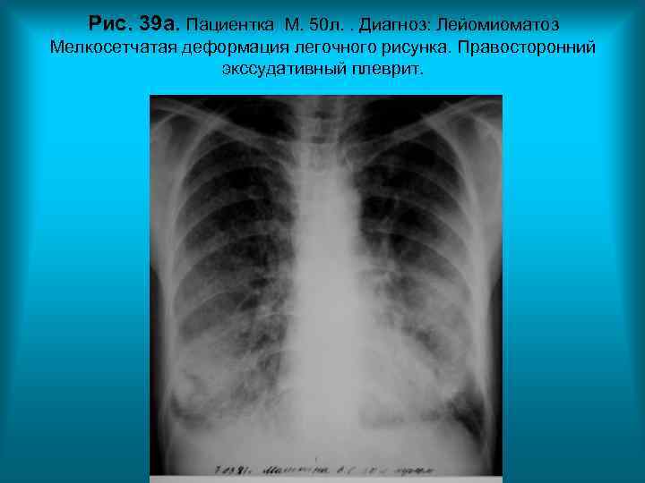 Рис. 39 а. Пациентка М. 50 л. . Диагноз: Лейомиоматоз Мелкосетчатая деформация Рис. 39 а. Пациентка М. 50 л. . Диагноз: Лейомиоматоз Мелкосетчатая деформация