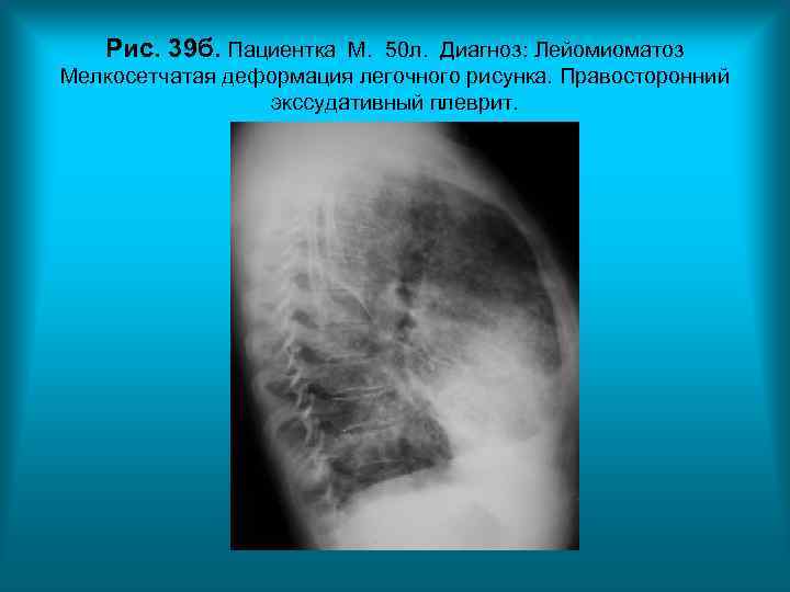 Рис. 39 б. Пациентка М. 50 л. Диагноз: Лейомиоматоз Мелкосетчатая деформация легочного Рис. 39 б. Пациентка М. 50 л. Диагноз: Лейомиоматоз Мелкосетчатая деформация легочного