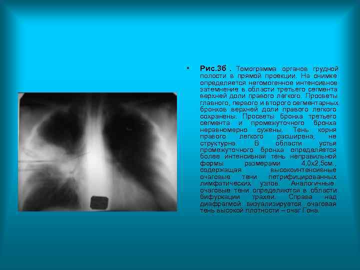 • Рис. 3 б . Томограмма органов грудной полости в прямой проекции. • Рис. 3 б . Томограмма органов грудной полости в прямой проекции.