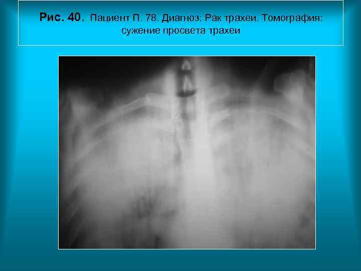 Рис. 40. Пациент П. 78. Диагноз: Рак трахеи. Томография: сужение просвета трахеи Рис. 40. Пациент П. 78. Диагноз: Рак трахеи. Томография: сужение просвета трахеи