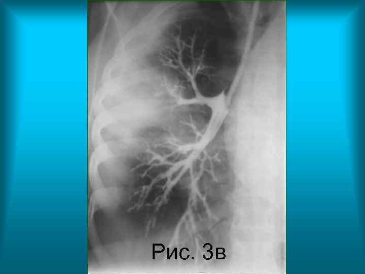 Рис. 3 в Н. С. Воротынцева. С. С. Гольев Рентгенопульмонология Рис. 3 в Н. С. Воротынцева. С. С. Гольев Рентгенопульмонология