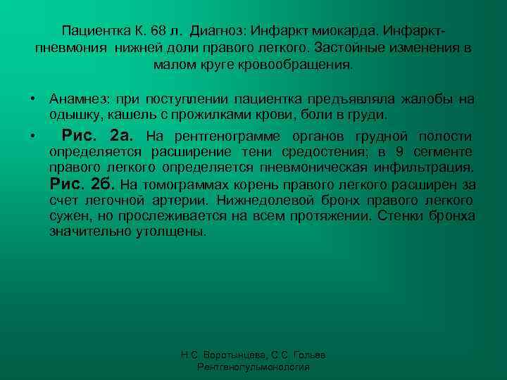   Пациентка К. 68 л. Диагноз: Инфаркт миокарда. Инфаркт- пневмония нижней доли правого