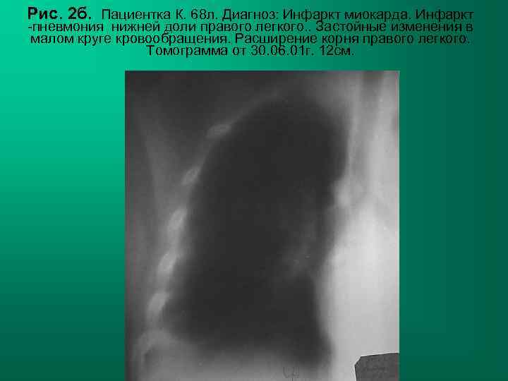 Рис. 2 б. Пациентка К. 68 л. Диагноз: Инфаркт миокарда. Инфаркт -пневмония нижней доли