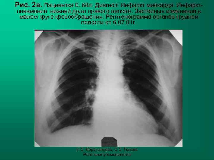 Рис. 2 в. Пациентка К. 68 л. Диагноз: Инфаркт миокарда. Инфаркт- пневмония нижней доли