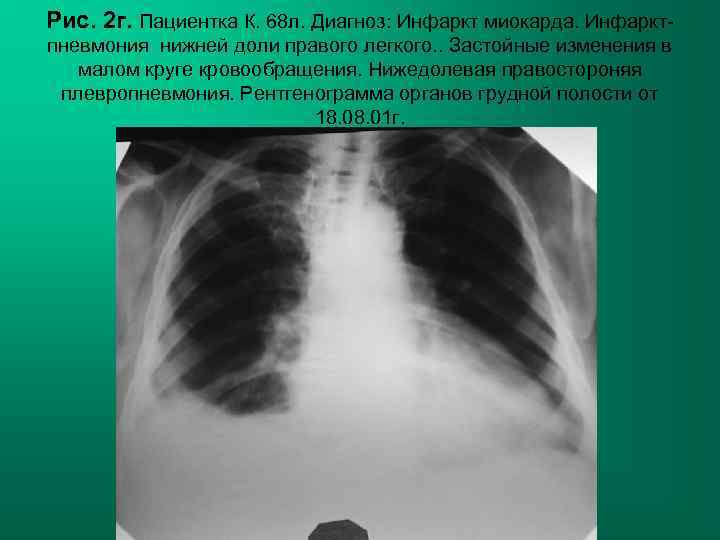Рис. 2 г. Пациентка К. 68 л. Диагноз: Инфаркт миокарда. Инфаркт- пневмония нижней доли
