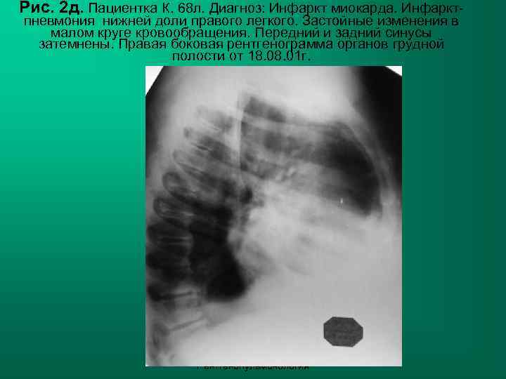 Рис. 2 д. Пациентка К. 68 л. Диагноз: Инфаркт миокарда. Инфаркт- пневмония нижней доли
