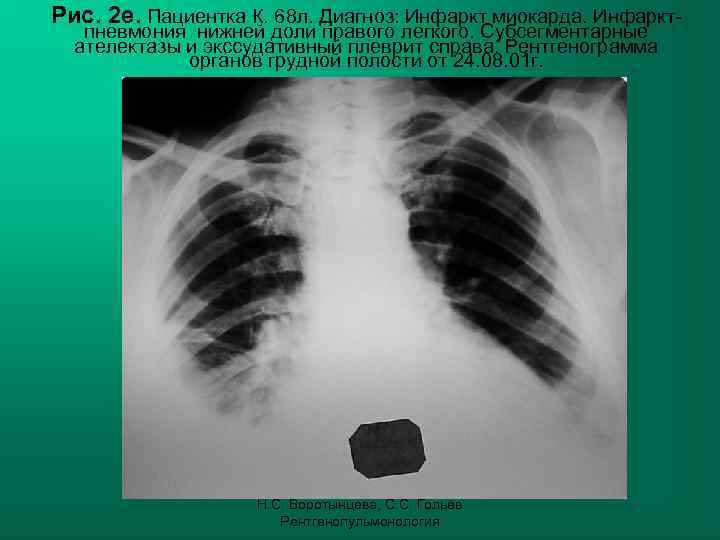 Рис. 2 е. Пациентка К. 68 л. Диагноз: Инфаркт миокарда. Инфаркт-  пневмония нижней