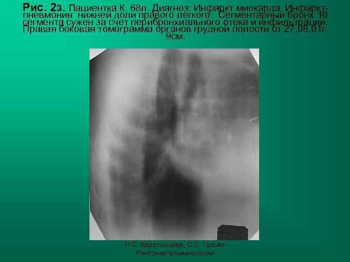 Рис. 2 з. Пациентка К. 68 л. Диагноз: Инфаркт миокарда. Инфаркт- пневмония нижней доли