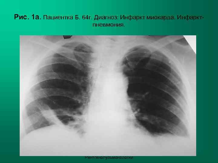 Рис. 1 а. Пациентка Б. 64 г. Диагноз: Инфаркт миокарда. Инфаркт-   
