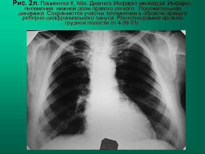 Рис. 2 л. Пациентка К. 68 л. Диагноз: Инфаркт миокарда. Инфаркт-  пневмония нижней