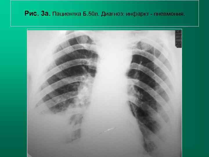 Рис. 3 а. Пациентка Б. 50 л. Диагноз: инфаркт - пневмония.   