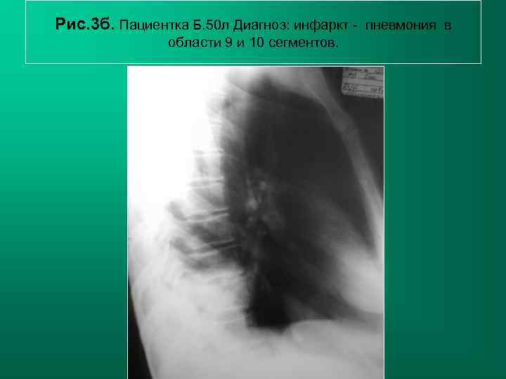 Рис. 3 б. Пациентка Б. 50 л Диагноз: инфаркт - пневмония в  