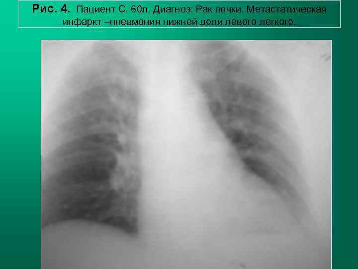Рис. 4. Пациент С. 60 л. Диагноз: Рак почки. Метастатическая  инфаркт –пневмония нижней