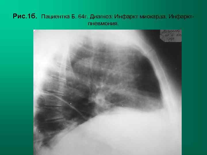 Рис. 1 б. Пациентка Б. 64 г. Диагноз: Инфаркт миокарда. Инфаркт-   