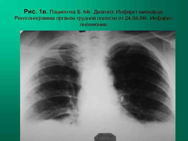   Рис. 1 в. Пациентка Б. 64 г. Диагноз: Инфаркт миокарда. Рентгенограмма органов