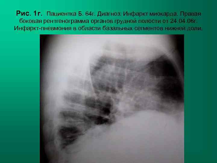 Рис. 1 г. Пациентка Б. 64 г. Диагноз: Инфаркт миокарда. Правая боковая рентгенограмма органов