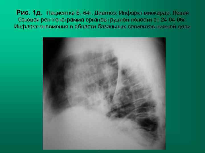 Рис. 1 д. Пациентка Б. 64 г. Диагноз: Инфаркт миокарда. Левая боковая рентгенограмма органов