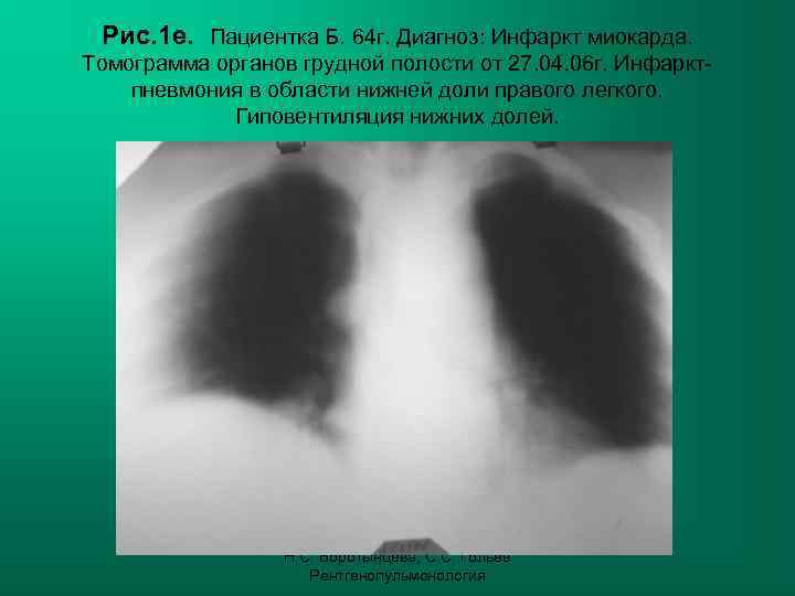  Рис. 1 е. Пациентка Б. 64 г. Диагноз: Инфаркт миокарда. Томограмма органов грудной