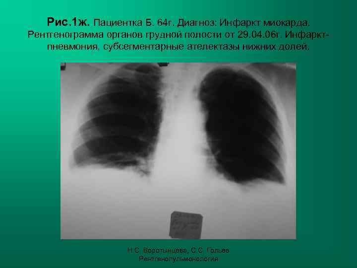   Рис. 1 ж. Пациентка Б. 64 г. Диагноз: Инфаркт миокарда. Рентгенограмма органов
